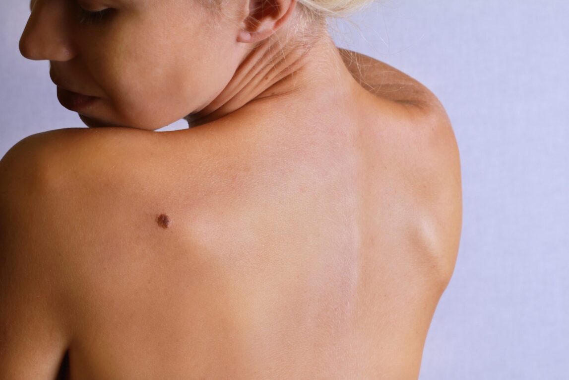 Melanoma's Hidden Defense How Nerve Growth Factor Helps Deadly Skin Cancer Evade the Immune System