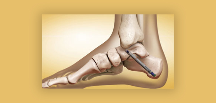 Ankle Fusion Nail Industry: Global Ankle Fusion Nail An Overview of its Use in Ankle Fusion Surgery